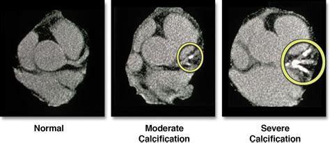 calcium ct scan