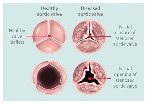 aortic valve stenosis